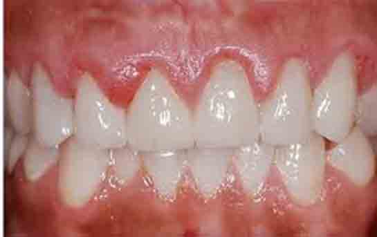 Diş Eti Ağrısı Belirtileri ve Tedavisi